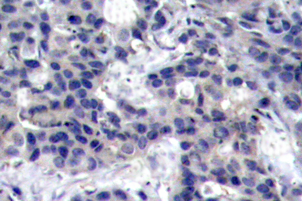 EIF2AK2 / PKR Antibody - IHC of PKR (K440) pAb in paraffin-embedded human breast carcinoma tissue.