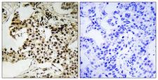 EIF2AK2 / PKR Antibody - Immunohistochemistry analysis of paraffin-embedded human breast carcinoma, using PKR (Phospho-Thr258) Antibody. The picture on the right is blocked with the phospho peptide.