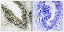 EIF2AK3 / PERK Antibody - Immunohistochemistry analysis of paraffin-embedded human colon carcinoma, using PEK/PERK Antibody. The picture on the right is blocked with the synthesized peptide.