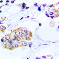 EIF2AK3 / PERK Antibody - Immunohistochemical analysis of PERK staining in human lung cancer formalin fixed paraffin embedded tissue section. The section was pre-treated using heat mediated antigen retrieval with sodium citrate buffer (pH 6.0). The section was then incubated with the antibody at room temperature and detected using an HRP polymer system. DAB was used as the chromogen. The section was then counterstained with hematoxylin and mounted with DPX.