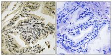 EIF2AK3 / PERK Antibody - Immunohistochemistry analysis of paraffin-embedded human prostate carcinoma, using PEK/PERK (Phospho-Thr981) Antibody. The picture on the right is blocked with the phospho peptide.