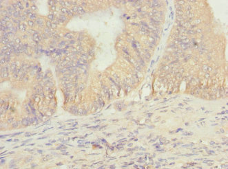 EIF2B1 Antibody - Immunohistochemistry of paraffin-embedded human prostate cancer at dilution 1:100