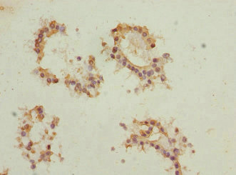 EIF2B1 Antibody - Immunohistochemistry of paraffin-embedded human breast cancer at dilution 1:100