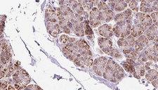 EIF2B1 Antibody - 1:100 staining human pancreas carcinoma tissue by IHC-P. The sample was formaldehyde fixed and a heat mediated antigen retrieval step in citrate buffer was performed. The sample was then blocked and incubated with the antibody for 1.5 hours at 22°C. An HRP conjugated goat anti-rabbit antibody was used as the secondary.