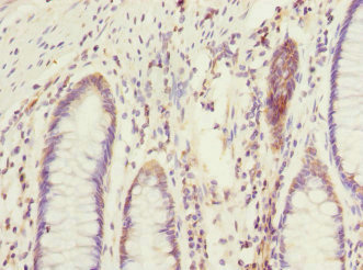 EIF2B2 Antibody - Immunohistochemistry of paraffin-embedded human colon cancer at dilution 1:100