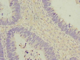 EIF2B2 Antibody - Immunohistochemistry of paraffin-embedded human ovarian cancer at dilution 1:100