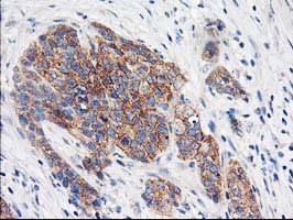 EIF2B3 Antibody - IHC of paraffin-embedded Adenocarcinoma of Human breast tissue using anti-EIF2B3 mouse monoclonal antibody. (Heat-induced epitope retrieval by 10mM citric buffer, pH6.0, 100C for 10min).