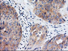 EIF2B3 Antibody - IHC of paraffin-embedded Carcinoma of Human bladder tissue using anti-EIF2B3 mouse monoclonal antibody. (Heat-induced epitope retrieval by 10mM citric buffer, pH6.0, 100C for 10min).