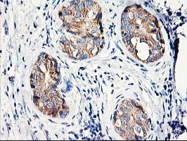 EIF2B3 Antibody - IHC of paraffin-embedded Adenocarcinoma of Human breast tissue using anti-EIF2B3 mouse monoclonal antibody.