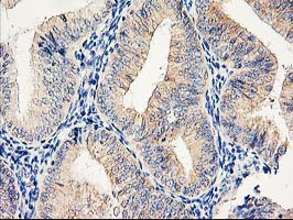 EIF2B3 Antibody - IHC of paraffin-embedded Adenocarcinoma of Human endometrium tissue using anti-EIF2B3 mouse monoclonal antibody.