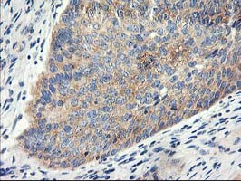EIF2B3 Antibody - IHC of paraffin-embedded Carcinoma of Human bladder tissue using anti-EIF2B3 mouse monoclonal antibody.