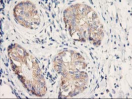 EIF2B3 Antibody - IHC of paraffin-embedded Adenocarcinoma of Human breast tissue using anti-EIF2B3 mouse monoclonal antibody. (Heat-induced epitope retrieval by 10mM citric buffer, pH6.0, 100C for 10min).