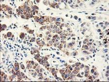 EIF2B3 Antibody - IHC of paraffin-embedded Carcinoma of Human lung tissue using anti-EIF2B3 mouse monoclonal antibody.