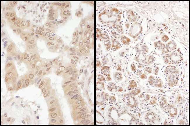 EIF2B4 Antibody - Detection of Human eIF2B delta/EIF2B4 by Immunohistochemistry. Samples: FFPE sections of human colon carcinoma and breast carcinoma. Antibody: Affinity purified rabbit anti-eIF2B delta/EIF2B4 used at a dilution of 1:200 (1 ug/ml). Detection: DAB.