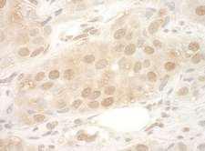 EIF2B5 Antibody - Detection of Human eIF2B5 by Immunohistochemistry. Sample: FFPE section of human breast carcinoma. Antibody: Affinity purified rabbit anti-eIF2B5 used at a dilution of 1:1000 (1 Detection: DAB.