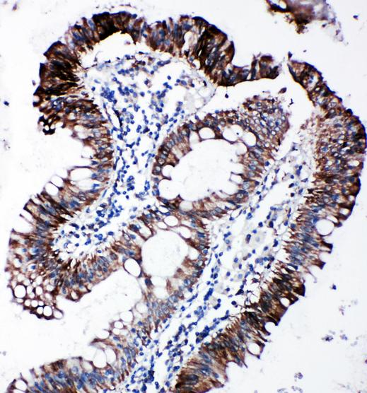 EIF2S1 Antibody - EIF2S1 antibody. IHC(P): Human Intestinal Cancer Tissue.