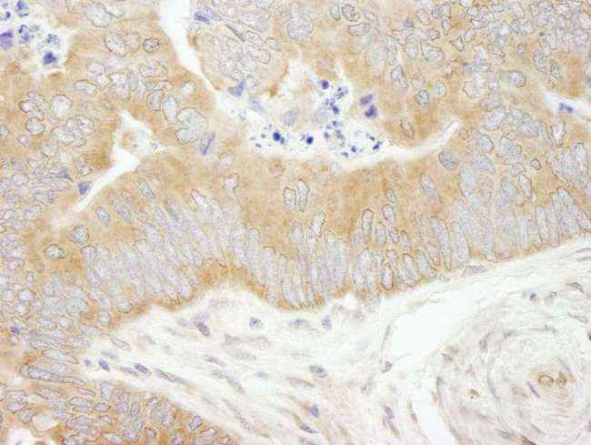 EIF2S1 Antibody - Detection of Human eIF2alpha/EIF2S1 by Immunohistochemistry. Sample: FFPE section of human colon carcinoma. Antibody: Affinity purified rabbit anti-eIF2alpha/EIF2S1 used at a dilution of 1:500. Epitope Retrieval Buffer-High pH (IHC-101J) was substituted for Epitope Retrieval Buffer-Reduced pH.