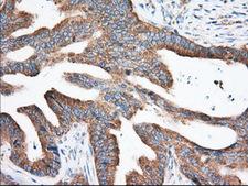 EIF2S1 Antibody - Immunohistochemical staining of paraffin-embedded Adenocarcinoma of Human colon tissue using anti-EIF2S1 mouse monoclonal antibody. (Dilution 1:50).
