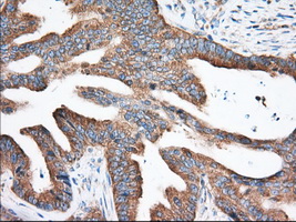 EIF2S1 Antibody - Immunohistochemical staining of paraffin-embedded Adenocarcinoma of Human colon tissue using anti-EIF2S1 mouse monoclonal antibody. (Dilution 1:50).