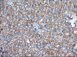 EIF2S1 Antibody - Immunohistochemical staining of paraffin-embedded Adenocarcinoma of Human ovary tissue using anti-EIF2S1 mouse monoclonal antibody. (Dilution 1:50).