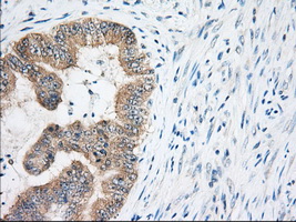 EIF2S1 Antibody - IHC of paraffin-embedded Adenocarcinoma of Human colon tissue using anti-EIF2S1 mouse monoclonal antibody. (Dilution 1:50).