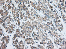 EIF2S1 Antibody - IHC of paraffin-embedded Carcinoma of Human liver tissue using anti-EIF2S1 mouse monoclonal antibody. (Dilution 1:50).