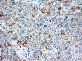EIF2S1 Antibody - IHC of paraffin-embedded Adenocarcinoma of Human ovary tissue using anti-EIF2S1 mouse monoclonal antibody. (Dilution 1:50).