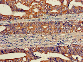 EIF2S1 Antibody - Immunohistochemistry of paraffin-embedded human colon cancer using EIF2S1 Antibody at dilution of 1:100
