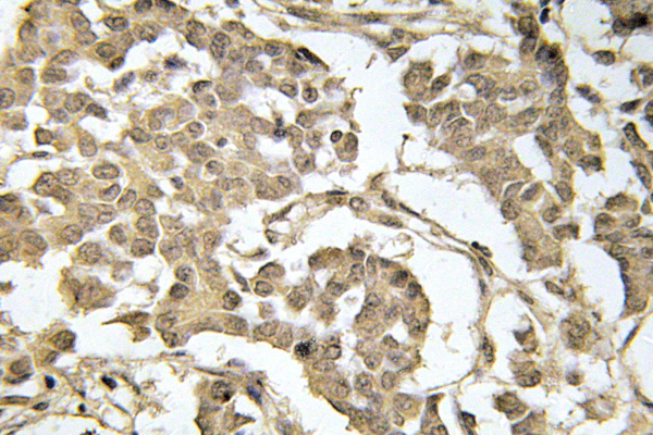 EIF2S1 Antibody - IHC of p-eIF2 (S51) pAb in paraffin-embedded human breast carcinoma tissue.