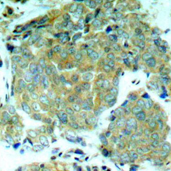 EIF2S1 Antibody - Immunohistochemical analysis of paraffin-embedded human breast carcinoma tissue.