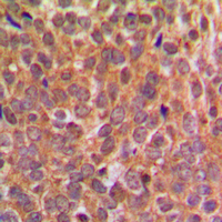 EIF2S1 Antibody - Immunohistochemical analysis of EIF2S1 (pS51) staining in human breast cancer formalin fixed paraffin embedded tissue section. The section was pre-treated using heat mediated antigen retrieval with sodium citrate buffer (pH 6.0). The section was then incubated with the antibody at room temperature and detected using an HRP conjugated compact polymer system. DAB was used as the chromogen. The section was then counterstained with hematoxylin and mounted with DPX.