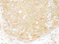 EIF2S2 Antibody - Detection of Human eIF2beta/EIF2S2 by Immunohistochemistry. Sample: FFPE section of human breast carcinoma. Antibody: Affinity purified rabbit anti-eIF2beta/EIF2S2 used at a dilution of 1:250.