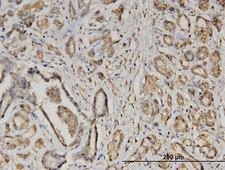 EIF2S2 Antibody - Immunoperoxidase of monoclonal antibody to EIF2S2 on formalin-fixed paraffin-embedded human pancreatic cancer. [antibody concentration 3 ug/ml]