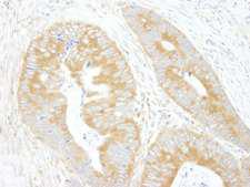 EIF3A Antibody - Detection of Human eIF3A/eIF3S10 by Immunohistochemistry. Sample: FFPE section of human colon carcinoma. Antibody: Affinity purified rabbit anti-eIF3A/eIF3S10 used at a dilution of 1:250. Epitope Retrieval Buffer-High pH (IHC-101J) was substituted for Epitope Retrieval Buffer-Reduced pH.