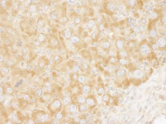 EIF3A Antibody - Detection of Mouse eIF3A/eIF3S10 by Immunohistochemistry. Sample: FFPE section of mouse renal cell carcinoma. Antibody: Affinity purified rabbit anti-eIF3A/eIF3S10 used at a dilution of 1:250. Epitope Retrieval Buffer-High pH (IHC-101J) was substituted for Epitope Retrieval Buffer-Reduced pH.