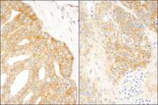 EIF3A Antibody - Detection of Human and Mouse eIF3A/EIF3S10 by Immunohistochemistry. Sample: FFPE section of human prostate carcinoma (left) and mouse teratoma (right). Antibody: Affinity purified rabbit anti-eIF3A/EIF3S10 used at a dilution of 1:200 (1 Detection: DAB.