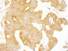 EIF3B Antibody - Detection of Human EIF3S9/eIF3B by Immunohistochemistry. Sample: FFPE section of human ovarian carcinoma. Antibody: Affinity purified rabbit anti-EIF3S9/eIF3B used at a dilution of 1:200 (1 Detection: DAB.