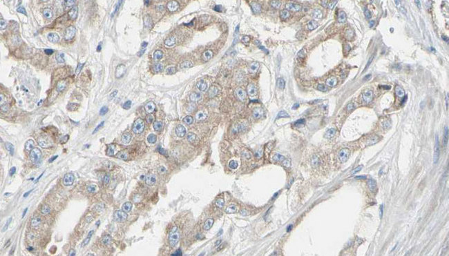EIF3B Antibody - 1:100 staining human prostate tissue by IHC-P. The sample was formaldehyde fixed and a heat mediated antigen retrieval step in citrate buffer was performed. The sample was then blocked and incubated with the antibody for 1.5 hours at 22°C. An HRP conjugated goat anti-rabbit antibody was used as the secondary.