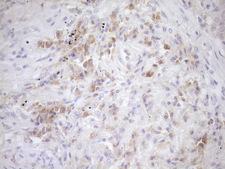 EIF3D Antibody - Immunohistochemical staining of paraffin-embedded Carcinoma of Human lung tissue using anti-EIF3D mouse monoclonal antibody. (Heat-induced epitope retrieval by Tris-EDTA, pH8.0)(1:150)