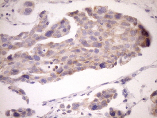 EIF3D Antibody - Immunohistochemical staining of paraffin-embedded Adenocarcinoma of Human ovary tissue using anti-EIF3D mouse monoclonal antibody. (Heat-induced epitope retrieval by Tris-EDTA, pH8.0)(1:150)