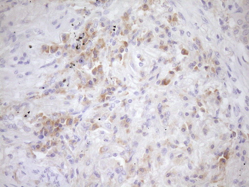 EIF3D Antibody - IHC of paraffin-embedded Carcinoma of Human lung tissue using anti-EIF3D mouse monoclonal antibody. (Heat-induced epitope retrieval by Tris-EDTA, pH8.0)(1:150).