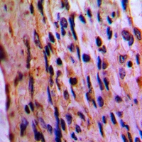 EIF3D Antibody - Immunohistochemical analysis of EIF3D staining in human lung cancer formalin fixed paraffin embedded tissue section. The section was pre-treated using heat mediated antigen retrieval with sodium citrate buffer (pH 6.0). The section was then incubated with the antibody at room temperature and detected with HRP and DAB as chromogen. The section was then counterstained with hematoxylin and mounted with DPX.