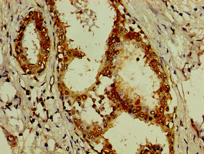 EIF3D Antibody - IHC image of EIF3D Antibody diluted at 1:200 and staining in paraffin-embedded human breast cancer performed on a Leica BondTM system. After dewaxing and hydration, antigen retrieval was mediated by high pressure in a citrate buffer (pH 6.0). Section was blocked with 10% normal goat serum 30min at RT. Then primary antibody (1% BSA) was incubated at 4°C overnight. The primary is detected by a biotinylated secondary antibody and visualized using an HRP conjugated SP system.
