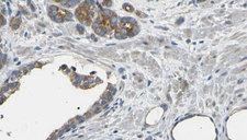 EIF3D Antibody - 1:100 staining human prostate tissue by IHC-P. The sample was formaldehyde fixed and a heat mediated antigen retrieval step in citrate buffer was performed. The sample was then blocked and incubated with the antibody for 1.5 hours at 22°C. An HRP conjugated goat anti-rabbit antibody was used as the secondary.