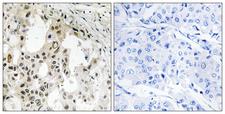 EIF3D Antibody - Peptide - + Immunohistochemistry analysis of paraffin-embedded human breast carcinoma tissue using EIF3D antibody.