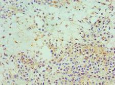 EIF3E Antibody - Immunohistochemistry of paraffin-embedded human breast cancer using antibody at 1:100 dilution.