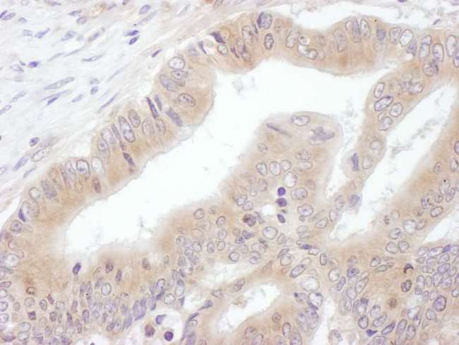 EIF3E Antibody - Detection of Human eIF3E by Immunohistochemistry. Sample: FFPE section of human ovarian carcinoma. Antibody: Affinity purified rabbit anti-eIF3E used at a dilution of 1:200 (1 ug/ml). Detection: DAB.