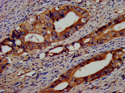 EIF3G Antibody - IHC image of EIF3G Antibody diluted at 1:400 and staining in paraffin-embedded human colon cancer performed on a Leica BondTM system. After dewaxing and hydration, antigen retrieval was mediated by high pressure in a citrate buffer (pH 6.0). Section was blocked with 10% normal goat serum 30min at RT. Then primary antibody (1% BSA) was incubated at 4°C overnight. The primary is detected by a biotinylated secondary antibody and visualized using an HRP conjugated SP system.