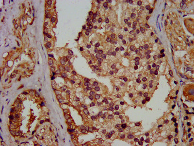 EIF3G Antibody - IHC image of EIF3G Antibody diluted at 1:400 and staining in paraffin-embedded human prostate cancer performed on a Leica BondTM system. After dewaxing and hydration, antigen retrieval was mediated by high pressure in a citrate buffer (pH 6.0). Section was blocked with 10% normal goat serum 30min at RT. Then primary antibody (1% BSA) was incubated at 4°C overnight. The primary is detected by a biotinylated secondary antibody and visualized using an HRP conjugated SP system.