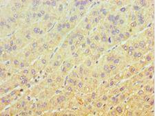 EIF3H / EIF3S3 Antibody - Immunohistochemistry of paraffin-embedded human liver cancer using antibody at 1:100 dilution.
